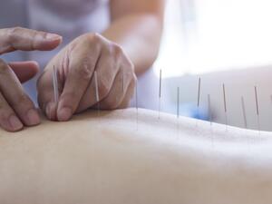 العلاج بالإبر،المستمد من الطب الصيني القديم قد يكون بديلاً لعلاج أعراض الدورة (Shutterstock)
