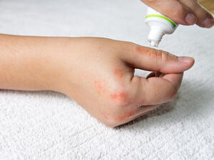 عدم التخوف من استخدام كريمات الكورتيزون ‏ ‏لعلاج مرضى "الاكزيما"