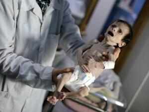 الطفلة سحر التي كانت تعاني من سوء تغذية في عيادة في الحمورية

