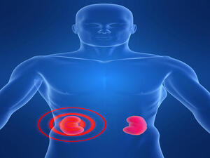 An illustration of kidney inflammation (Shutterstock/Sebastian Kaulitzki)  
