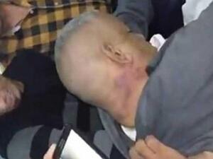  آثار التعذيب على طلعت شبيب (47 عاما)