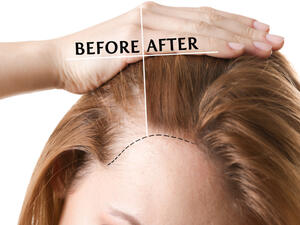لعمليّة زراعة الشّعر بعض المخاطر كالعمليّات الجراحيّة الأخرى كالنزف والعدوى
