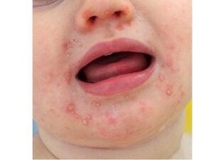 Hand, Mouth, and Foot Disease.