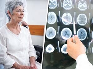 مرض الزهايمر مرض العصر الحديث 