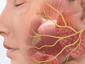 التهاب العصب السابع