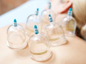 الحجامة نوعان جافة ورطبة