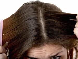 طبيب البوابة: زيت النيم للتخلص من قشرة الرأس