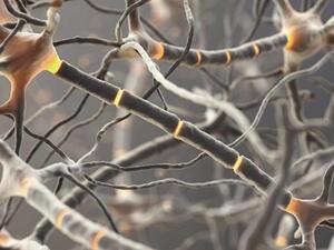 متلازمة غيلان باريه