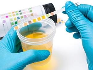 فحص البول يكشف الاصابة ببكتيريا المسالك البولية