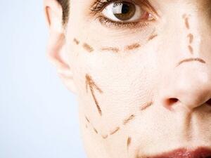 تخطيط مبدئي يسبق عملية شد الوجه