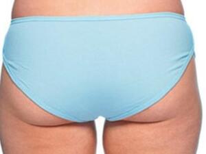 السيلوليات مشكلة تعاني منها 1 من كل 10 نساء