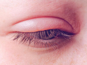 التهاب الجفن هو التهاب للحد الخارجي للجفن يؤدي الى الاحمرار وشعور بالحكة