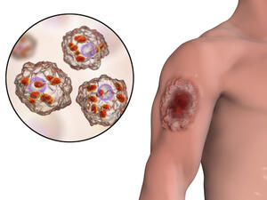 مرض اللشمانيا هو مرض طفيلي المنشأ ينتقل عن طريق قرصة ذبابة الرمل