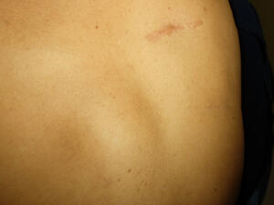 الورم الشحمي هو ورم حميد يتكون من خلايا الدهون ناعمة الملمس

