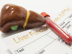 من علامات ارتفاع انزيمات الكبد خروج بول وبراز بلون داكن