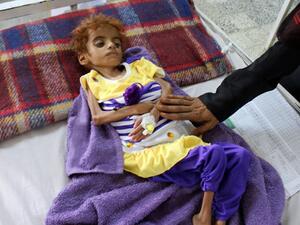 A Yemeni child suffering from malnutrition is measured at a hospital in the Hajjah province, western Yemen. (AFP/File)