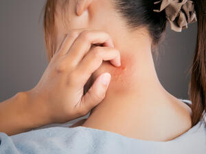 كثيرًا ما نتعرض للدغات أو عضات البعوض خصوصاً في فصل الصيف