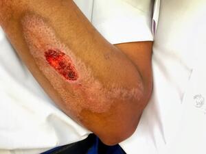 من أعراض تجلط الدم وجود تورّمات في مكان تخثّر الدّم