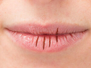 مرض السكري من العوامل التي تؤدي إلى جفاف الفم واللسان