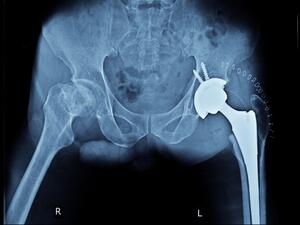 احتمال إصابة المسنين بكسور الحوض، يقل إذا ما كانوا متزوجين!
