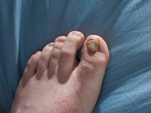 تعتبر فطريات الأظافر من أكثر الأمراض والإصابات الكبيرة التي يعاني منها الأشخاص