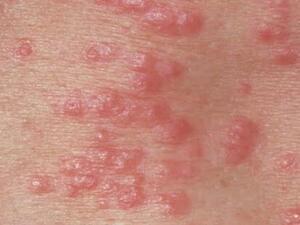 مرض التينيا هو مرض جلدي عبارة عن عدوي فطرية تصيب الجلد 