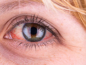 الاحمرار يعد حدثًا طارئًا ويختفي بمجرد الاستيقاظ من النوم بعد التعب