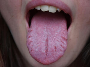 من أسباب تشققات اللسان الضغوطات النفسيّة والشعور بحالة من القلق