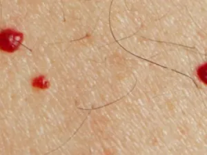 تناول الأدوية التي لها أعراض جانبية كظهور البقع وانتشارها
