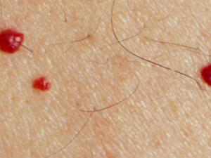 تناول الأدوية التي لها أعراض جانبية كظهور البقع وانتشارها