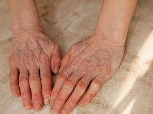 تظهر العروق أو الأوعية الدّموية البارزة عند بعض الأشخاص ويكون سببها خلقي