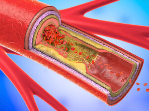 أسباب ضيق الشرايين ارتفاع الكولسترول الضار في الدم
