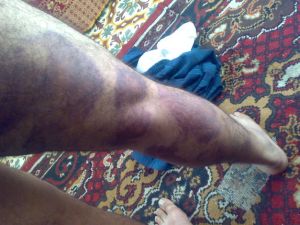 معتقل تعرض للتعذيب في سجن لحماس