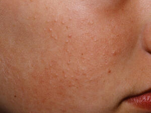 مرض النخالية البيضاء يؤثر في 5% من الأطفال في جميع أنحاء العالم

