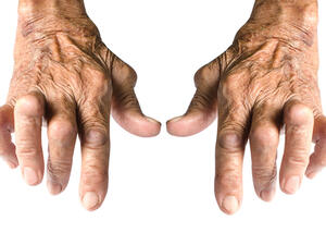 الوراثة تلعبُ دوراً بارزاً في سبب الإصابةِ بالتهاب المفاصل

