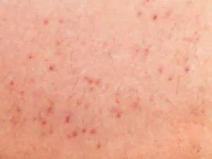 الجرب هو مرض يسبب ظهور حكة شديدة وتسبب هذه الحكة طفيليات عثية

