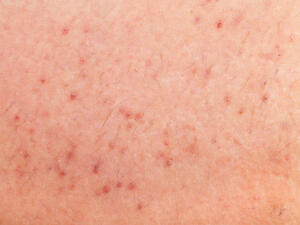 الجرب هو مرض يسبب ظهور حكة شديدة وتسبب هذه الحكة طفيليات عثية

