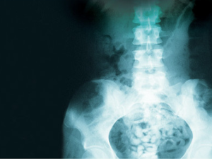 An X-Ray of the man's bowels show the mass of heroin pills. Not a nutritious lunch. (Image courtesy of 7Days)