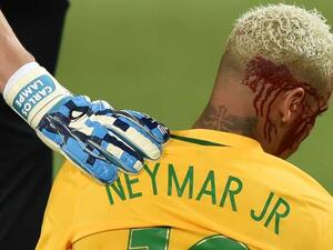 نيمار والدماء تسيل من وجهه