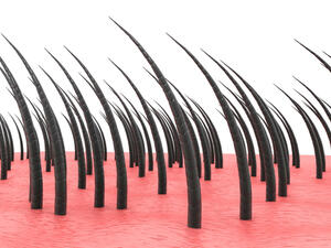 الشعر تحت الجلد مشكلةٌ تظهر عندما ينمو الشعر بشكل ملتوٍ تحت الجلد

