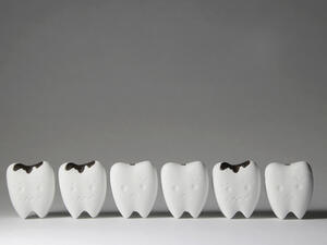 تسوس الاسنان عبارة عن أجزاء من أسنان مصابة بالتعفن قد يتطور إلى ثقوب