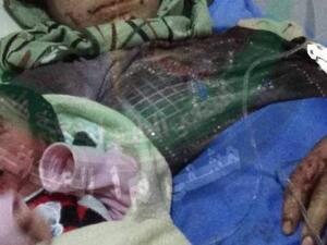 ويظهر الفيديو جرحا مفتوحاً فوق العين اليسرى للطفلة حيث كانت الشظية عالقة.