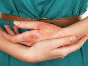 الحروق نوع من الإصابات الّتي تحدث في الجلد الخارجي للجسم

