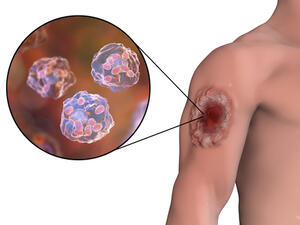 داء الليشمانيات عبارة عن عدوى طفيلية تنتقل عن طرق لسعة ذبابة صغيرة 
