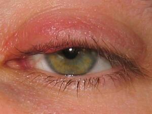 حساسية جفن العين تكون على شكل انتفاخات في الجفن

