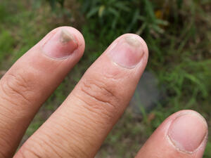 الفطريات حين تصيب الأظافر لا تذهب من تلقاء لابد من المعالجة