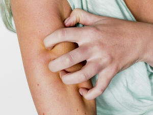 الثلج يقلل من ألم لسعات "الناموس"