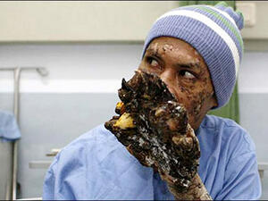 الرجل الشجرة اثناء العلاج