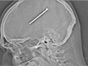 المسمار داخل الراس