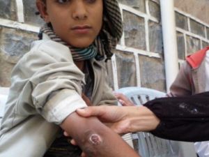 Naharri shows off his scars